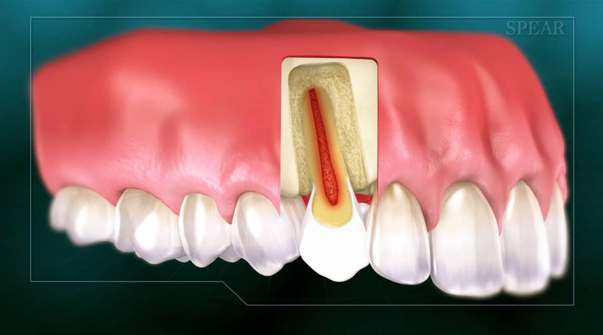 Tooth With Webbed Roots Web Archives - Brooks Stevens General Dentistry - Dr. Brooks Stevens ...